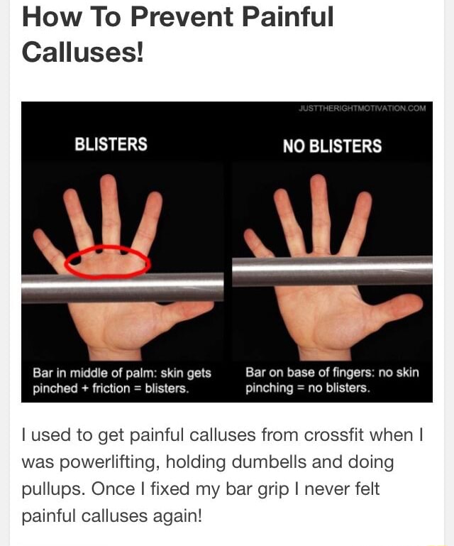 How To Prevent Painful Calluses! BLISTERS NO BLISTERS Bar in