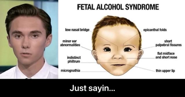 FETAL ALCOHOL SYNDROME low nasal bridge epicanthal folds short ...