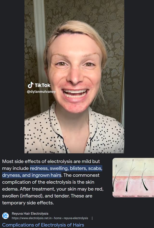 Dylan Mulvaney's electrolysis I TikTok dylanmulvaney Most side effects of electrolysis are Dylan Mulvaney's electrolysis I TikTok dylanmulvaney Most side effects of electrolysis are