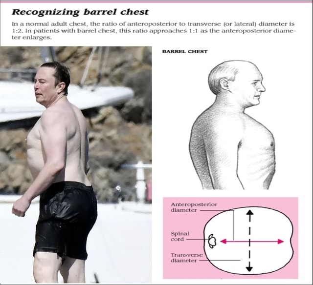 Recognizing barrel chest In a normal adult chest, the ratio of