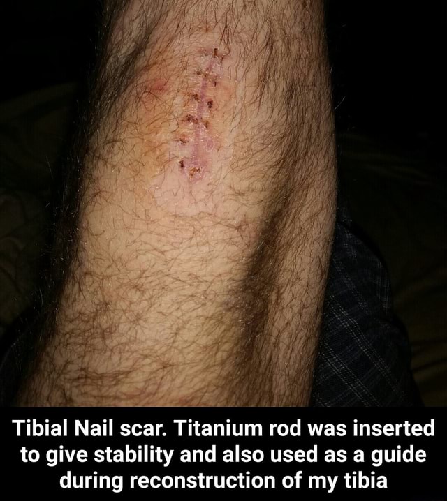 Ad Tibial Nail scar. Titanium rod was inserted to give stability and also used as a guide during