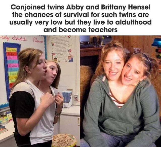 Conjoined twins Abby and Brittany Hensel the chances of survival