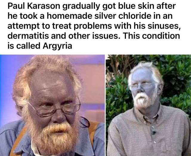 Blue man Paul Karason is still blue after he self-medicates with silver for  a skin condition