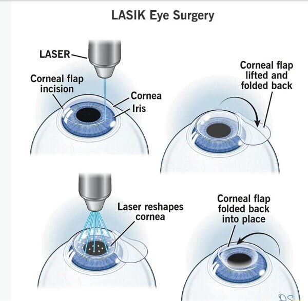 LASIK Eye Surgery Comeal flap Corneal fla lifted and incision folded ...