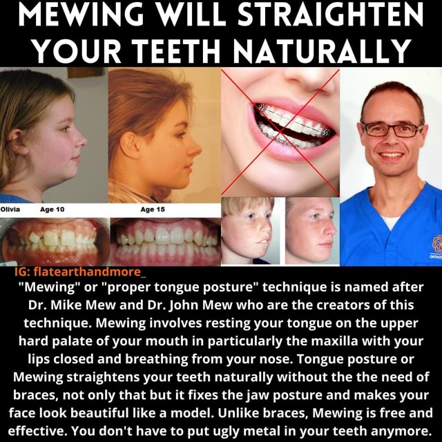 Can Mewing Straighten Teeth? Before & After Photos