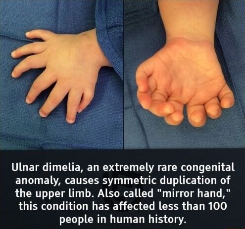 Ulnar dimelia, an extremely rare congenital anomaly, causes symmetric ...