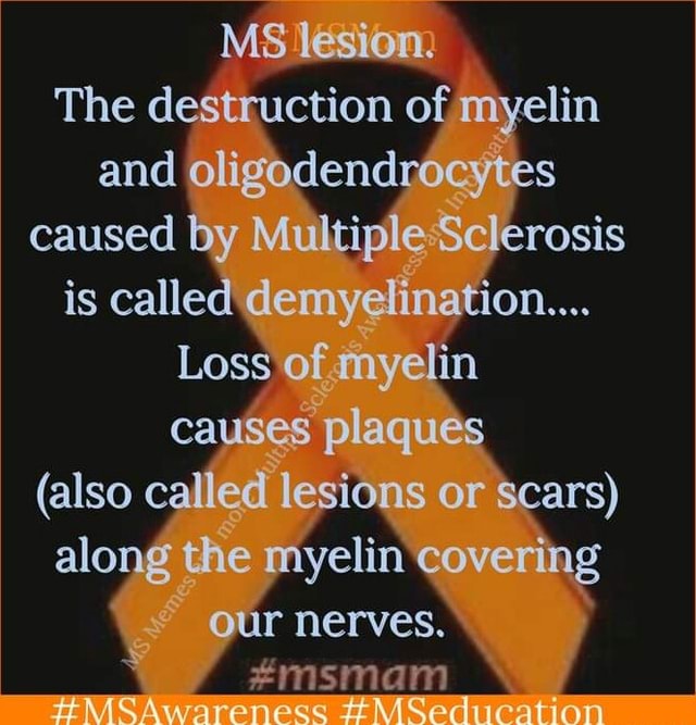 MS lesion. The destruction of myelin and oligodendrocytes caused by